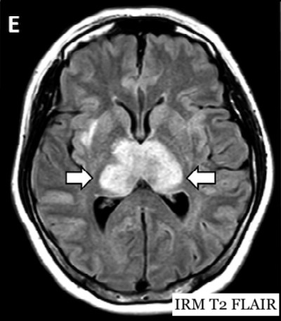 Premier cas de lésions cérébrales dues au COVID-19 à l'IRM