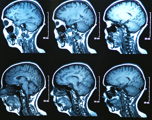 Le deep learning détecte automatiquement Six tumeurs cérébrales ...