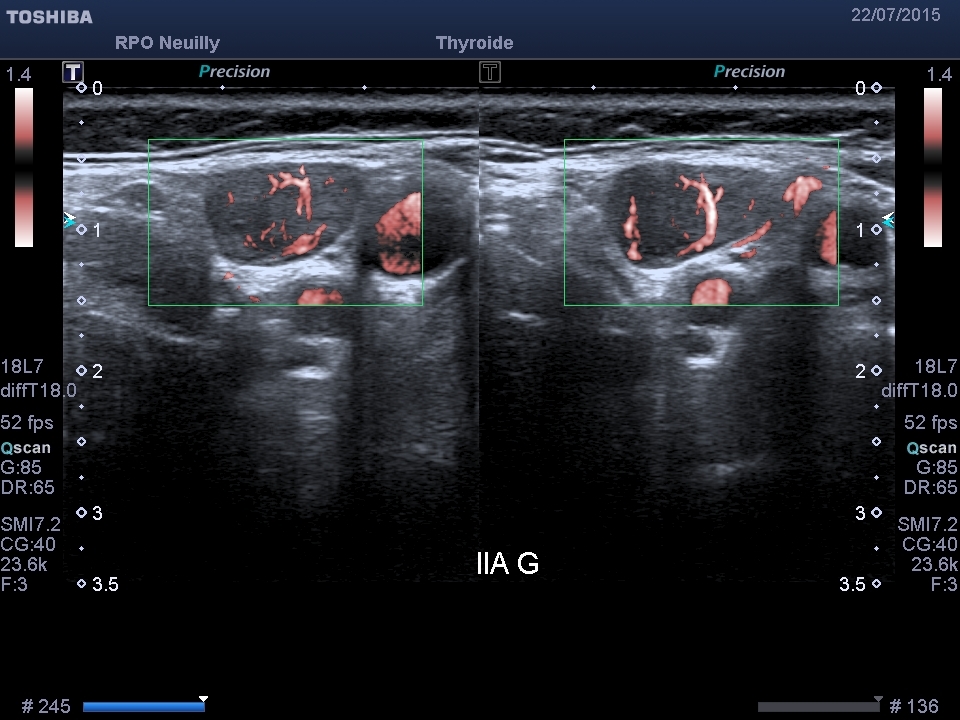 Fig.1: vascularisation d'un ganglion normal en c-SMI