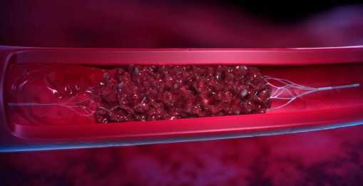 Thrombose