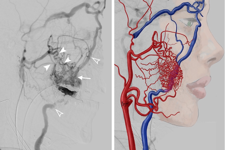 Revue D taill e Des Malformations Art rioveineuses
